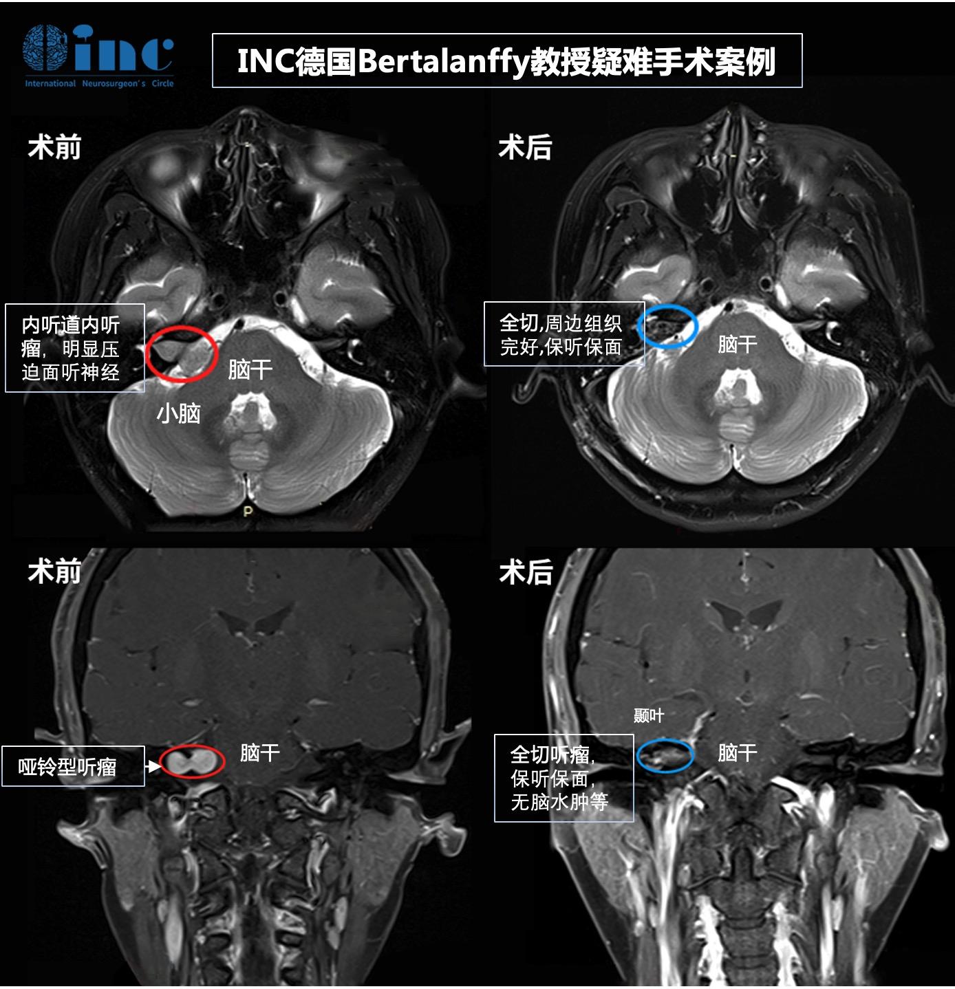 聽神經(jīng)瘤進(jìn)展會(huì)出現(xiàn)哪9大癥狀？治療后都能恢復(fù)嗎？手術(shù)關(guān)鍵是什么？