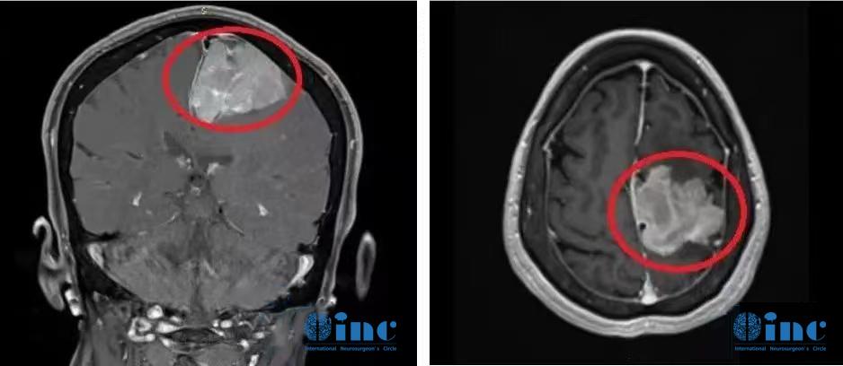 較大腦膜瘤長在大靜脈竇、大腦鐮旁能治愈嗎，復雜腦膜瘤的治療策略