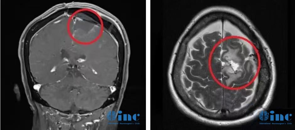 較大腦膜瘤長在大靜脈竇、大腦鐮旁能治愈嗎？復雜腦膜瘤的治療策略