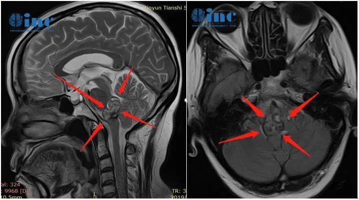 10年6次腦干出血，腦干海綿狀血管瘤手術(shù)后康復(fù)
