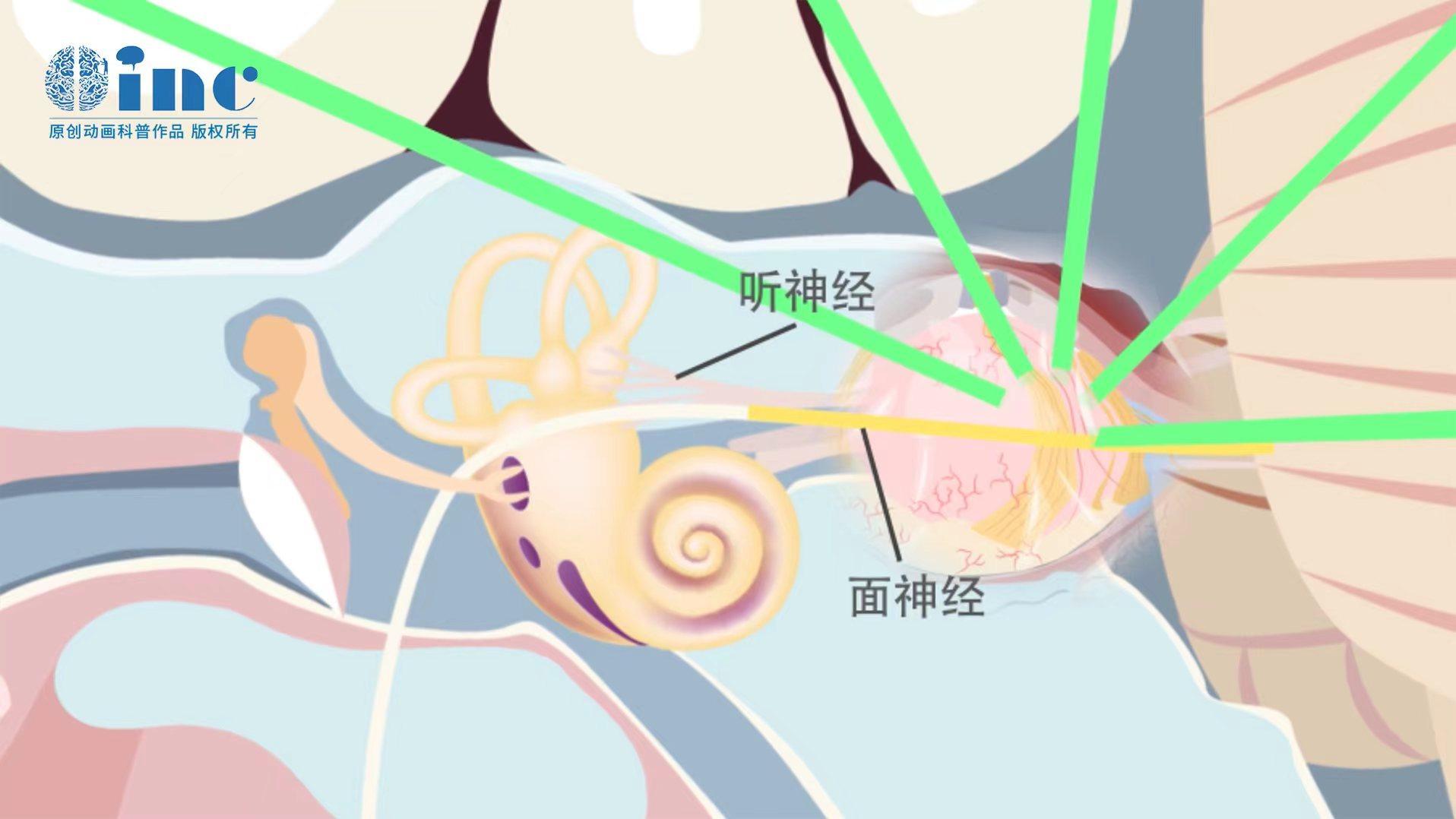 INC德國<a href='/guojizhuanjia/Bertalanffy.html' target='_blank'><u>巴特朗菲</u></a>教授的前沿手術(shù)理念——聽神經(jīng)瘤面癱的九大必知問題【術(shù)中篇】