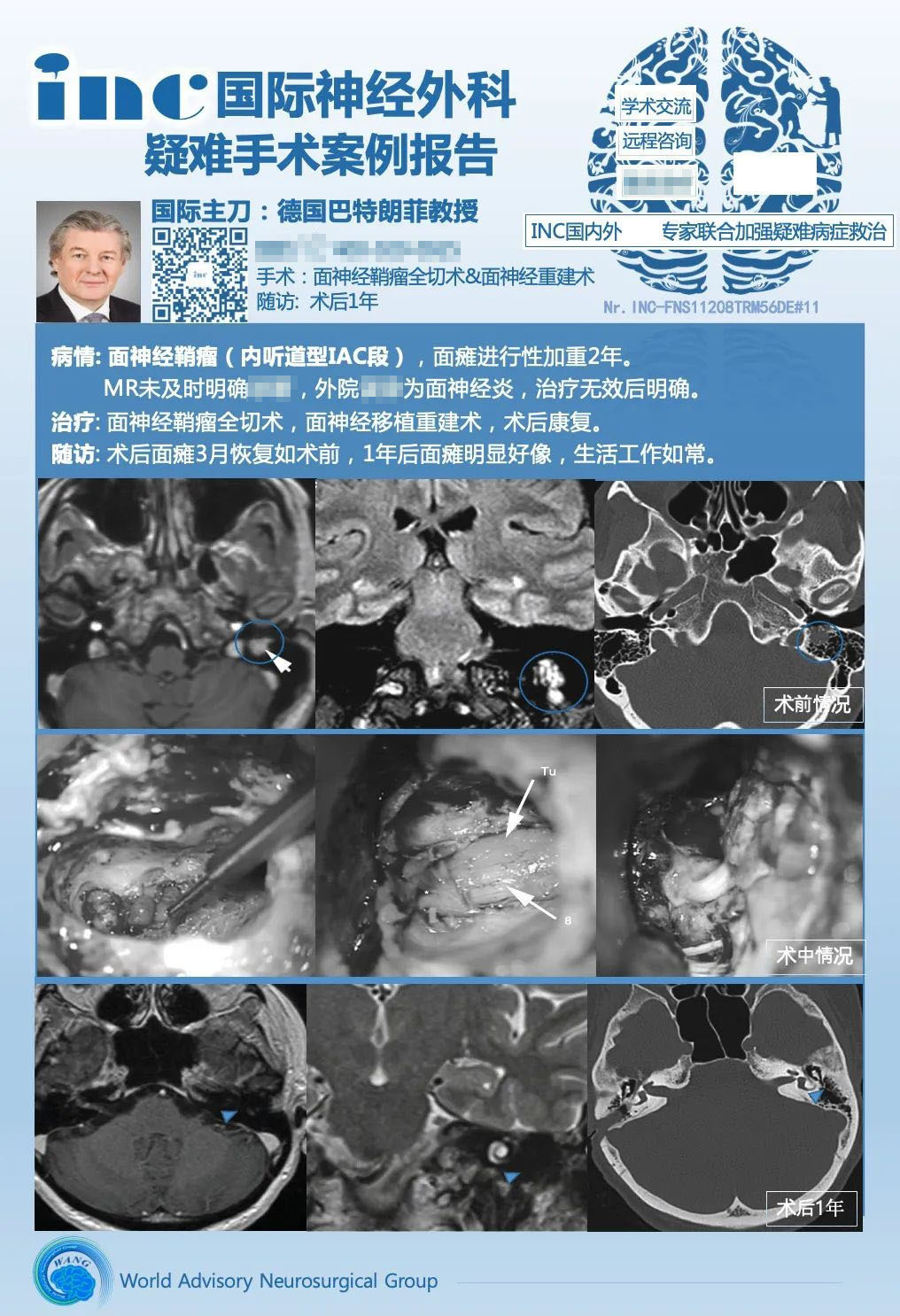警惕面癱竟是面神經(jīng)鞘瘤作祟，面神經(jīng)鞘瘤誤診、漏診怎么咨詢？