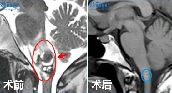 腦干海綿狀血管瘤出血和復(fù)發(fā)因素是什么？