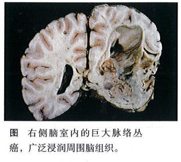 脈絡(luò)叢腫瘤有哪些分型？