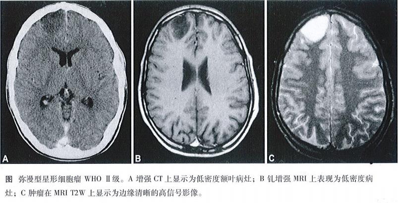 彌漫性低級別膠質(zhì)瘤生存期