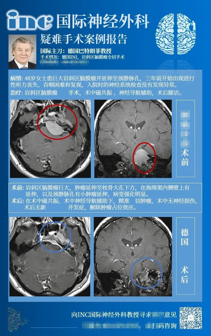 巖斜腦膜瘤手術(shù)入路案例