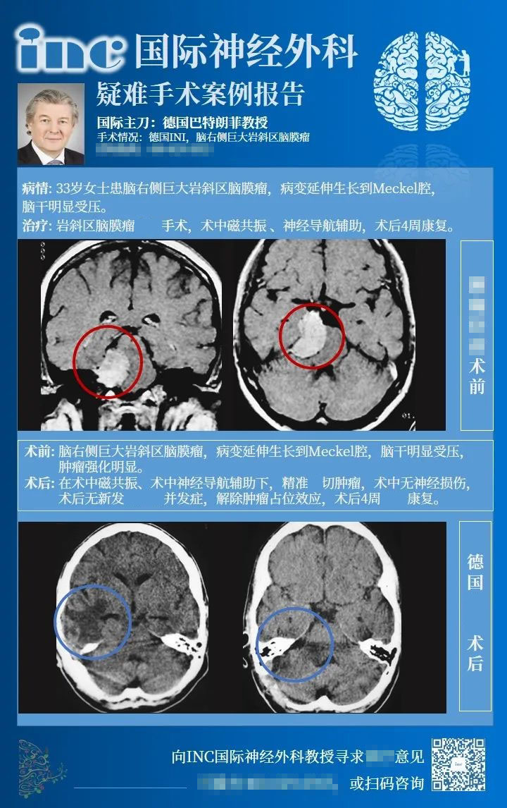 巖斜腦膜瘤手術(shù)入路案例1
