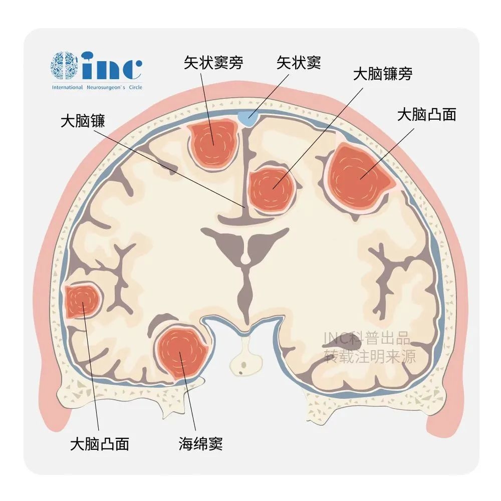 大腦鐮旁腦膜瘤能治好嗎
