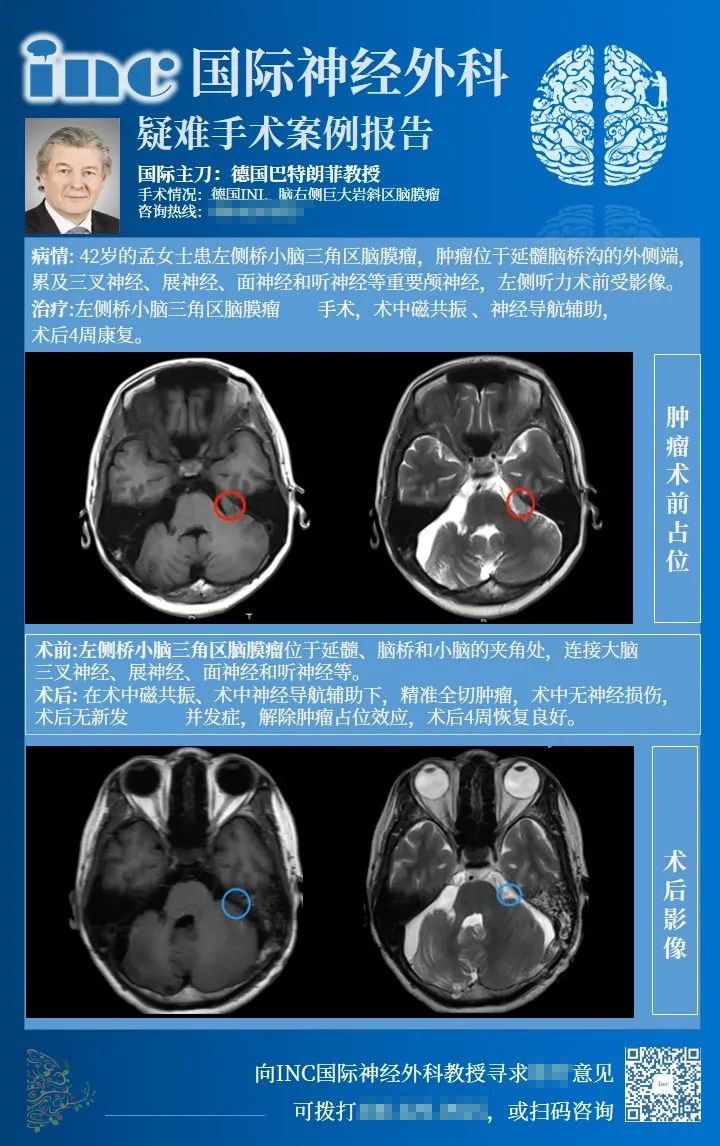 橋小腦角區(qū)腦膜瘤手術風險大嗎-1