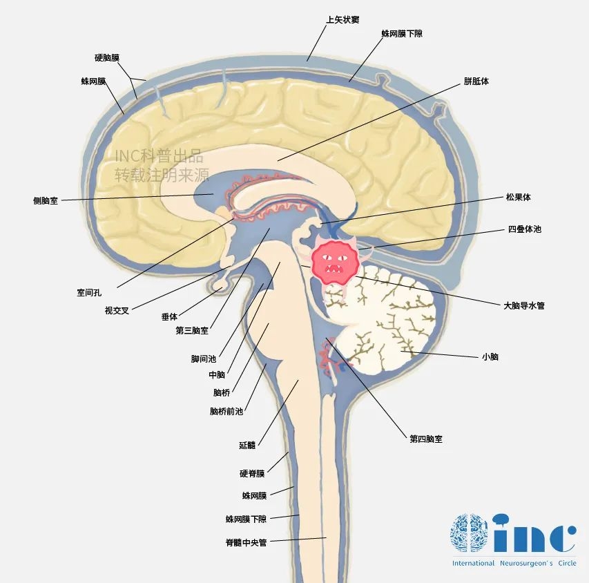 cpa區(qū)腦膜瘤多大要手術