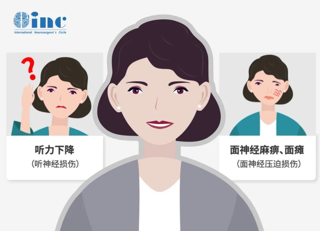 聽神經(jīng)瘤面癱