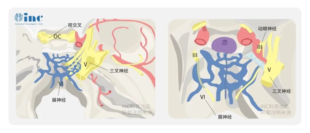 橋小腦角區(qū)腦膜瘤手術(shù)難度大嗎？