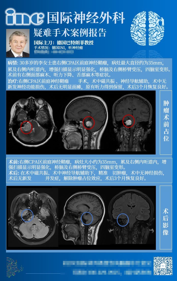 聽神經(jīng)瘤“保聽保面”手術(shù)治療