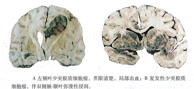 少突膠質(zhì)細(xì)胞瘤的特征表現(xiàn)是什么?