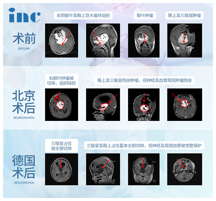 膠質(zhì)瘤案例