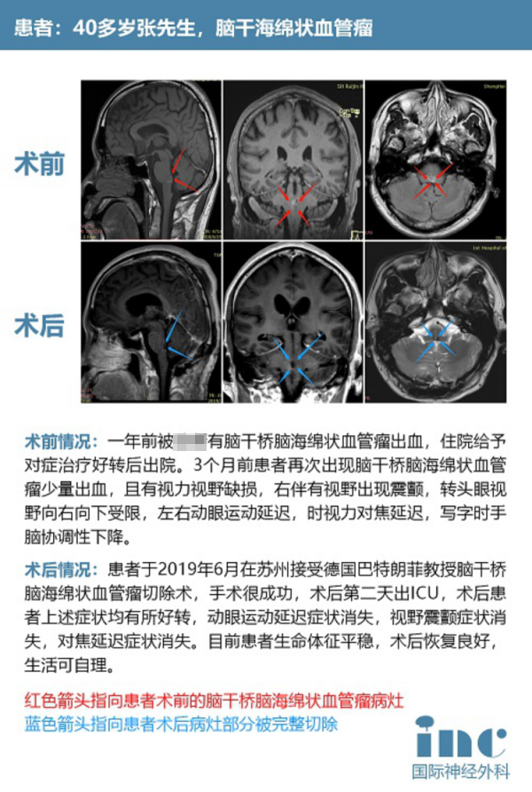 腦干海綿狀血管瘤手術(shù)治療案例