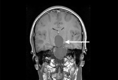 顱咽管瘤是惡性腫瘤嗎？