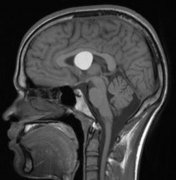 三腦室腫瘤治愈率是多少？手術(shù)并發(fā)癥有哪些？