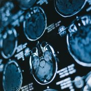 【腦腫瘤病因】腦腫瘤前兆與起因，10大信號(hào)需警惕！