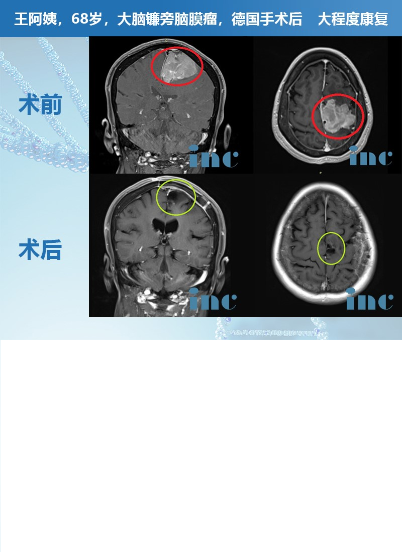 腦膜瘤案例