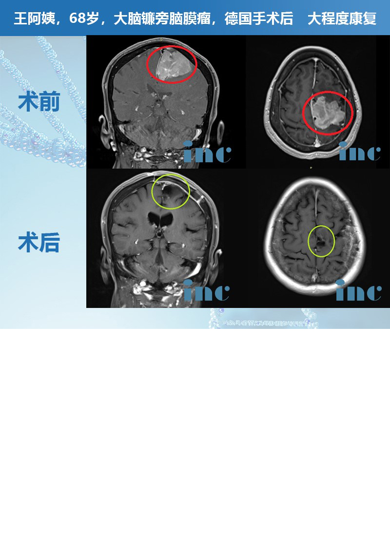 腦膜瘤
