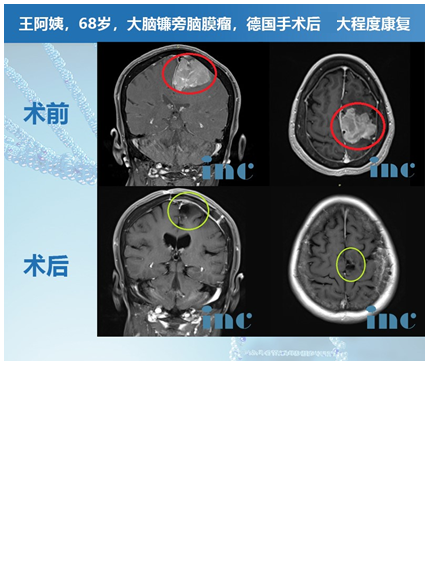 腦膜瘤案例