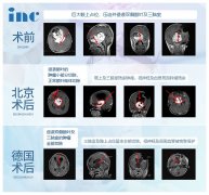 視神經(jīng)通路/下丘腦低級(jí)別膠質(zhì)瘤能治好嗎？