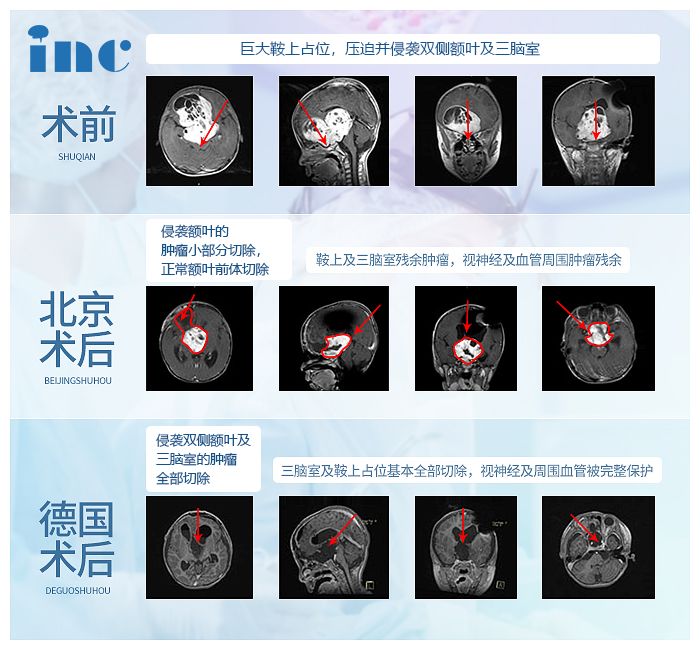 視神經(jīng)膠質(zhì)瘤