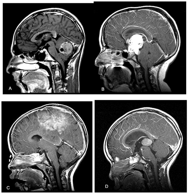 小兒腦腫瘤核磁成像