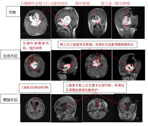 視神經(jīng)膠質(zhì)瘤案例