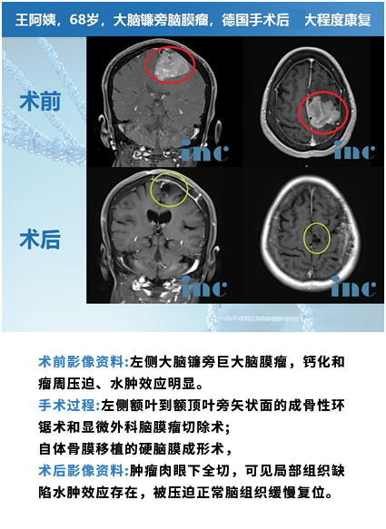 腦膜瘤案例