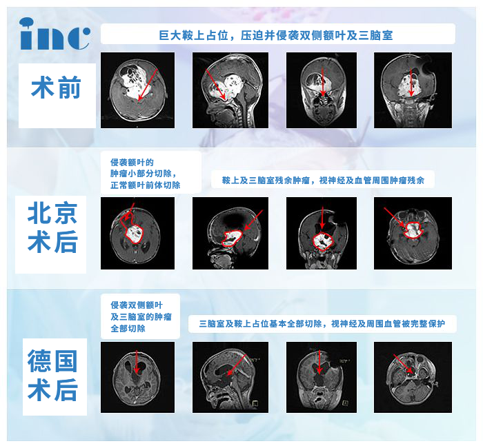 腦膠質(zhì)瘤案例