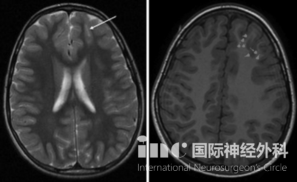 癲癇案例