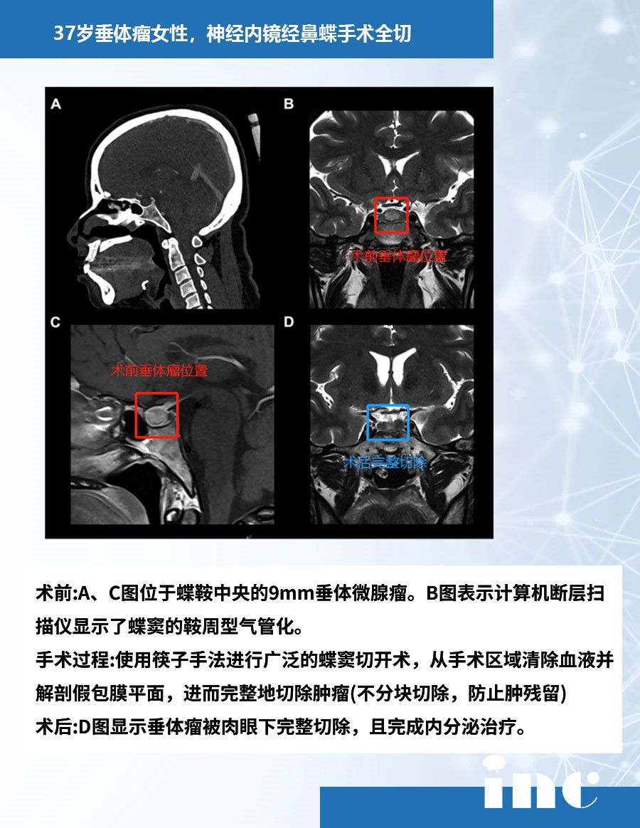 垂體瘤案例