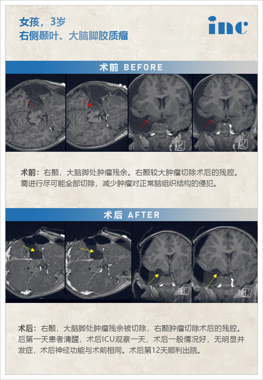 膠質(zhì)瘤案例