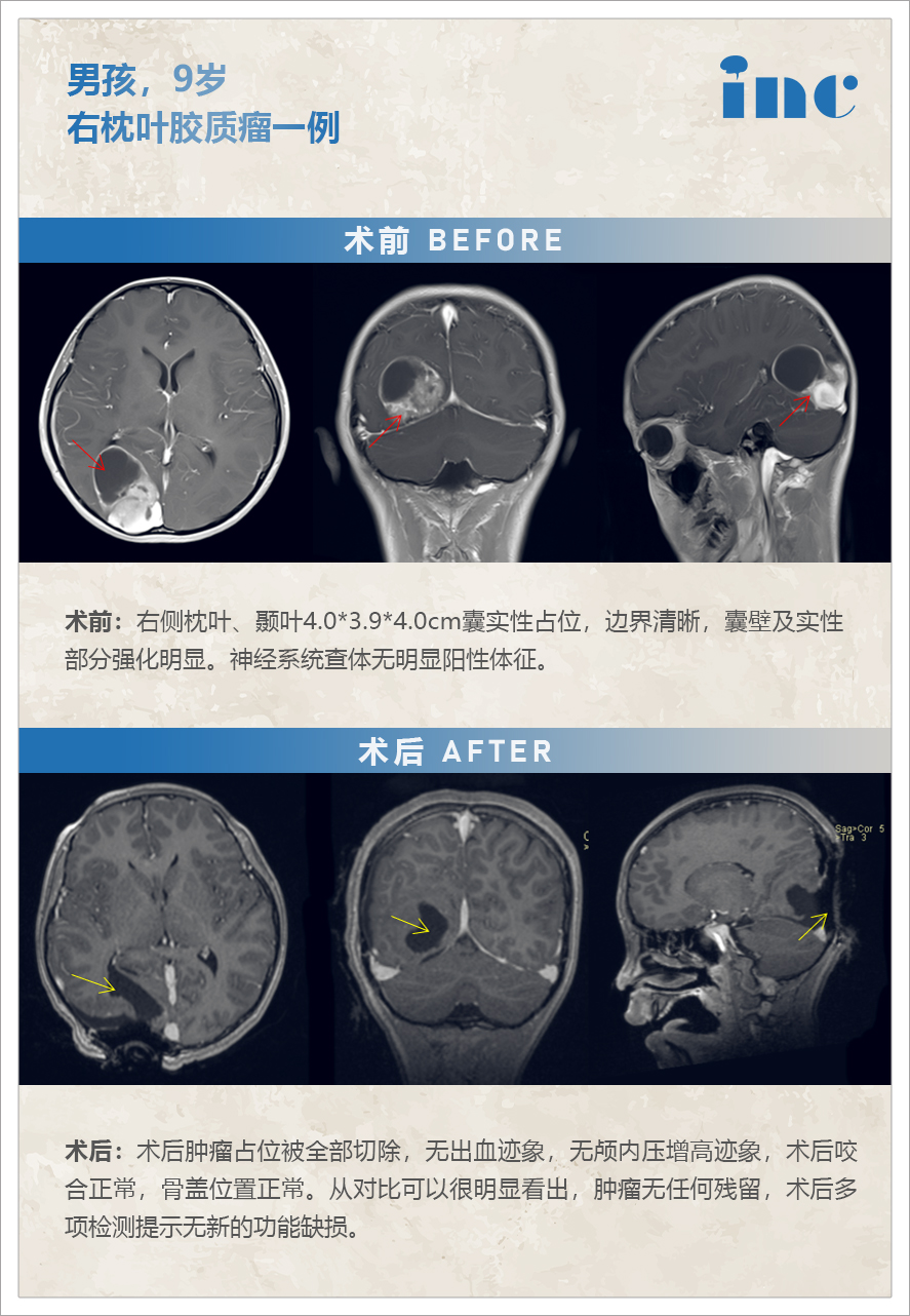 膠質(zhì)瘤案例