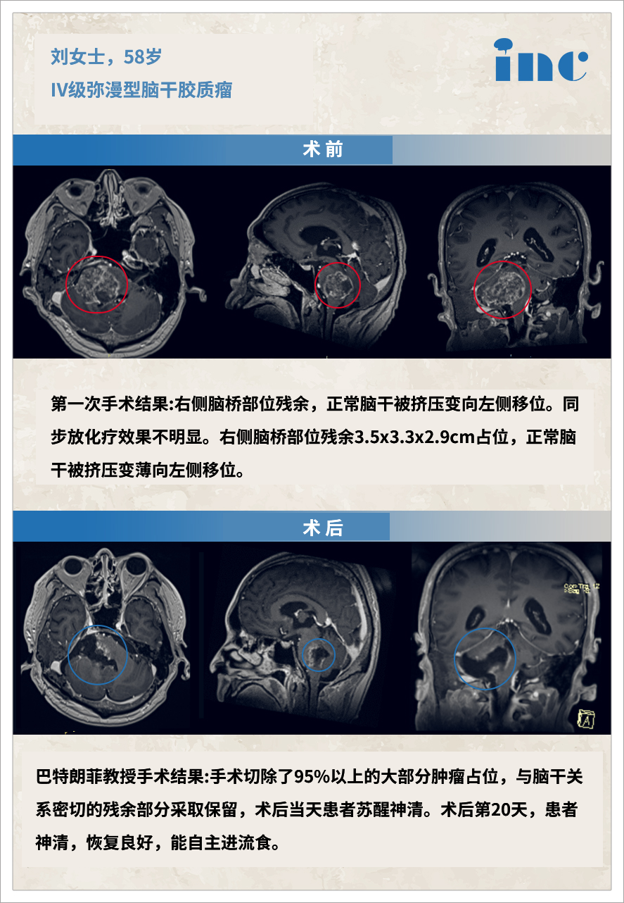 膠質(zhì)瘤案例