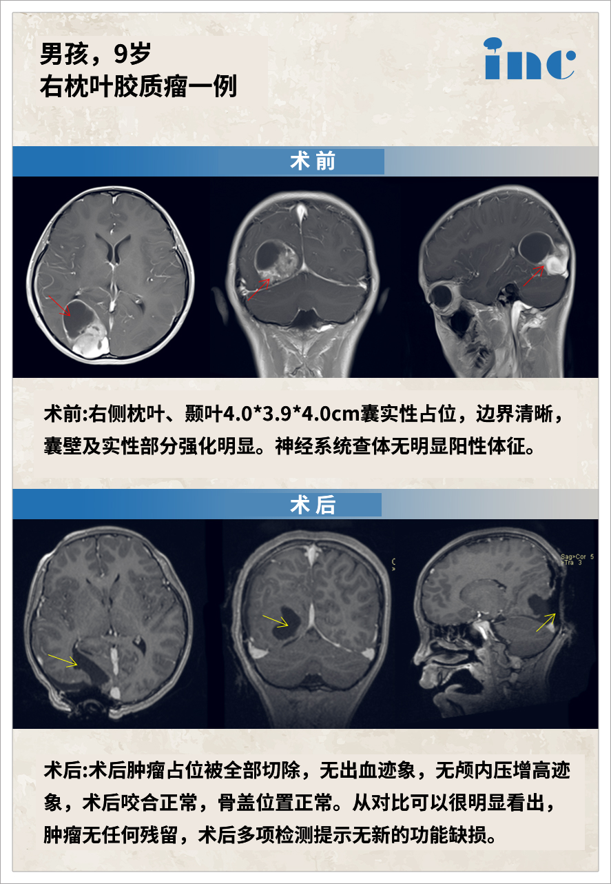 膠質(zhì)瘤案例