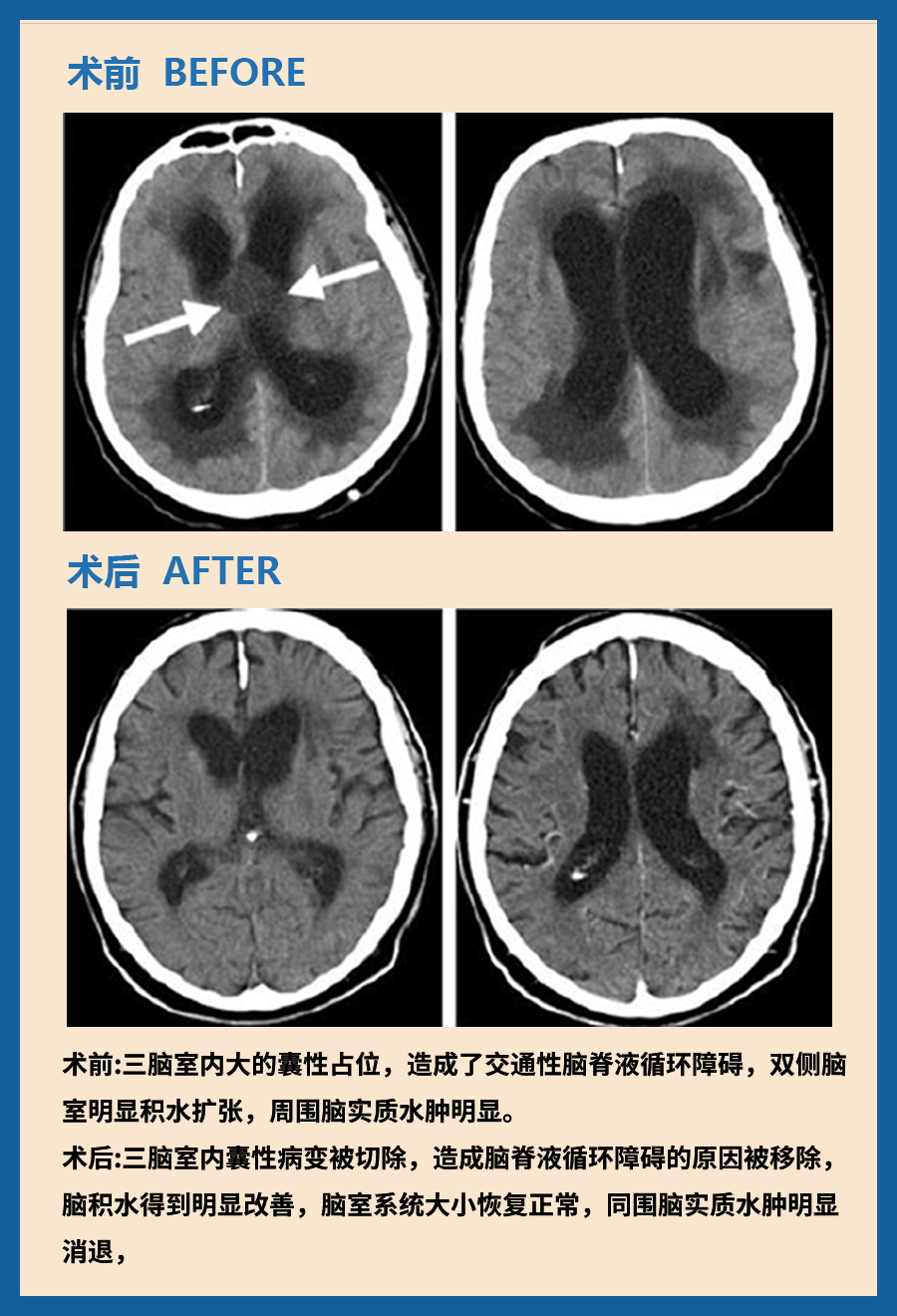 顱咽管瘤