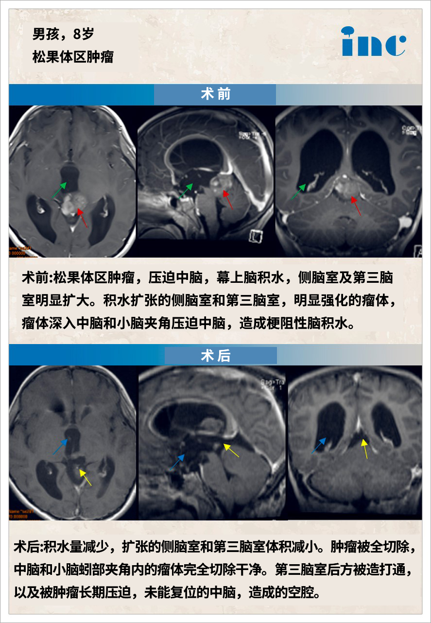 松果體區(qū)腫瘤案例