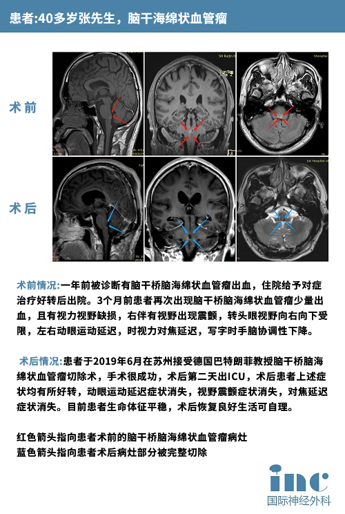 腦海綿狀血管瘤案例