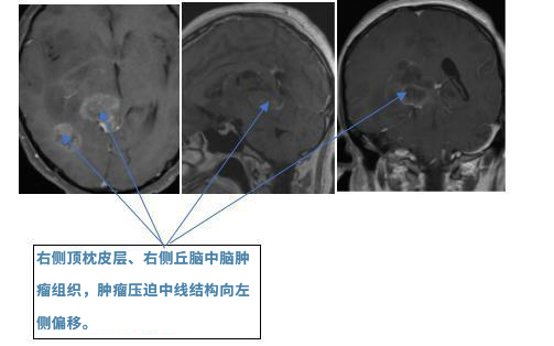 巴特朗菲教授手術(shù)過程