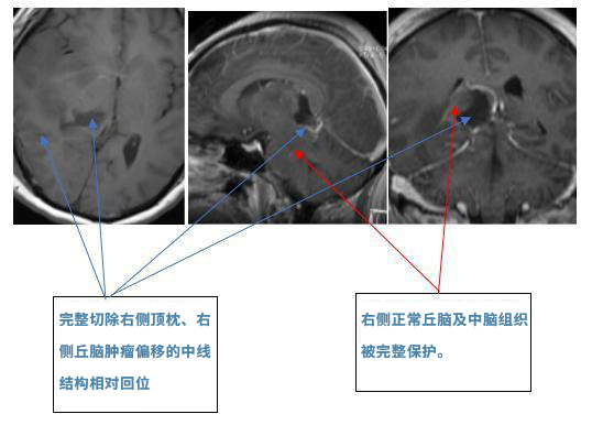 膠質(zhì)母細胞瘤案例