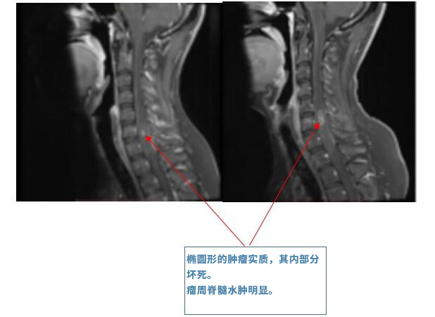 脊髓腫瘤