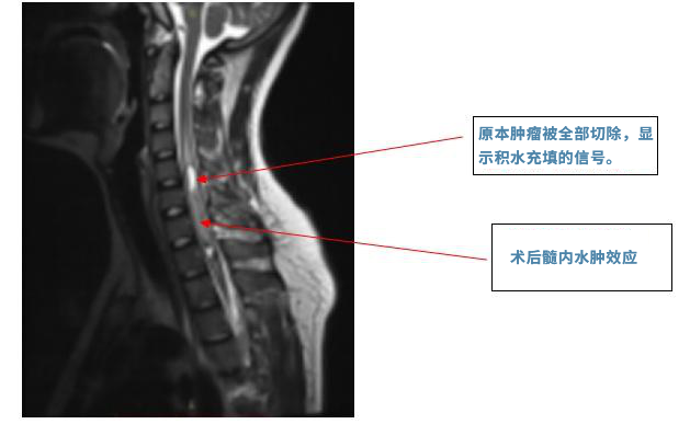 脊髓髓內腫瘤