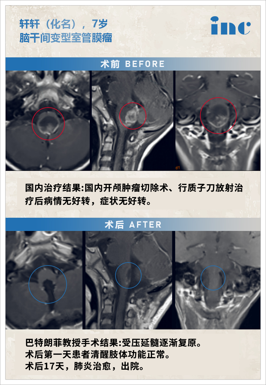 腦干腫瘤案例
