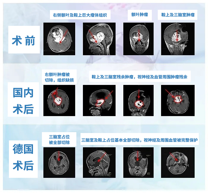 失明的5歲視神經(jīng)膠質(zhì)瘤患兒，