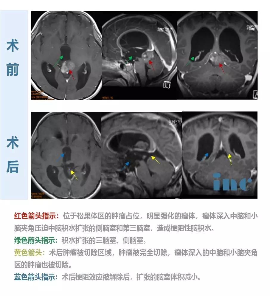 8歲松果體區(qū)腫瘤男孩