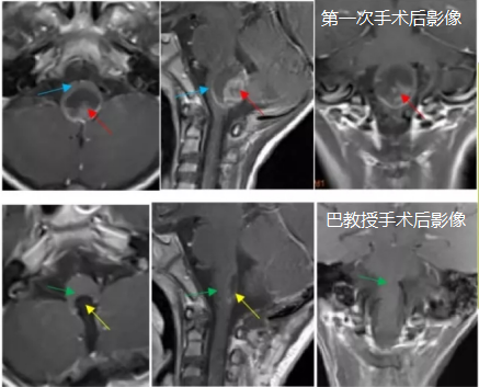7歲腦干室管膜瘤患兒，手術(shù)全切后恢復(fù)良好