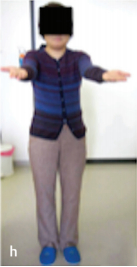 腦瘤術(shù)后